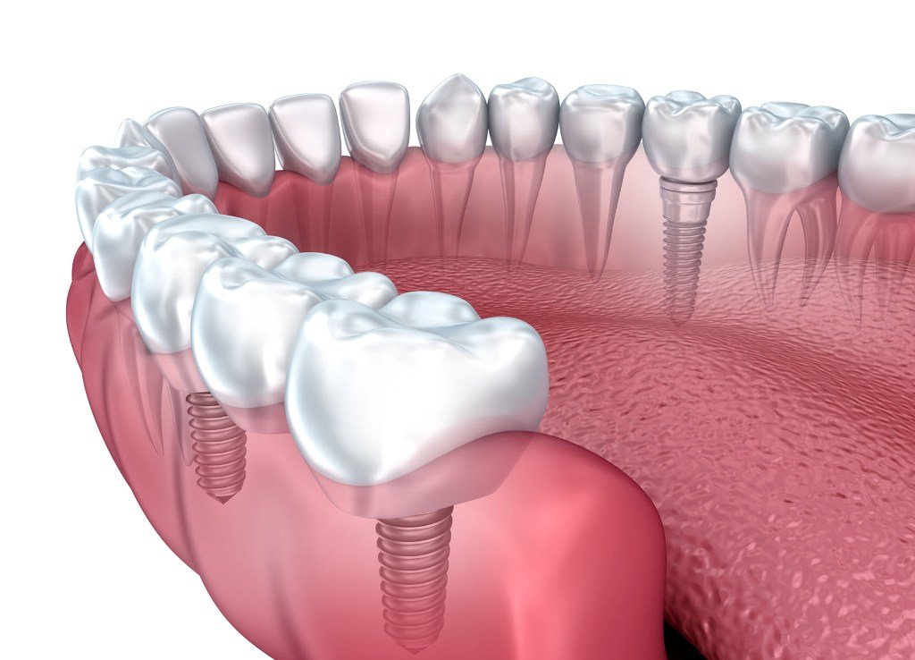 Can Dental Implants Cause Oral Cancer? » Wassup Mate